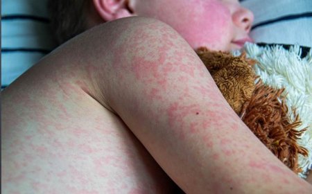 لە ئەمریکا نەخۆشیی سوورێژە بە چڕی بڵاوبووەتەوە